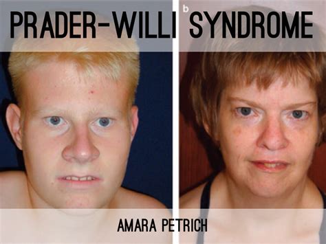 prada willi syndrom ehe belastung|prader willi syndrome weight loss.